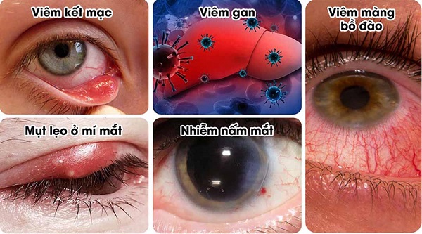 Các loại nhiễm trùng mắt thường gặp.